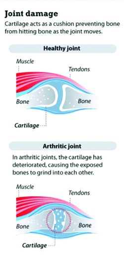 arthritis graphic